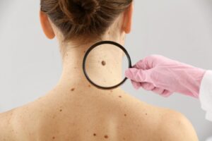 Xoá Nốt Ruồi Hiệu Quả Với Công Nghệ Laser